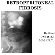 Retroperitoneal Fibrosis