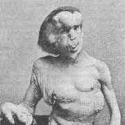 Joseph Merrick (The Elephant Man)