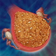 Gestational Trophoblastic Disease