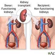 Kidney Transplants