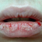 Chapped Lips