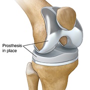 Knee Replacement