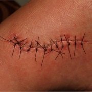 Get Stitches