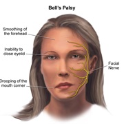 Bell's Palsy