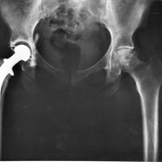 Hip Replacement