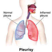 Pleurisy