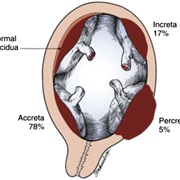 Placental Abnormality