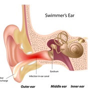 Swimmer's Ear