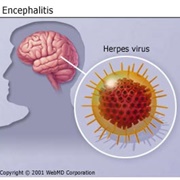 Encephalitis