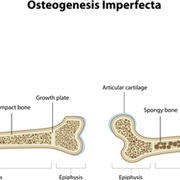 Osteogenesis Imperfecta