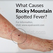 Rocky Mountain Spotted Fever