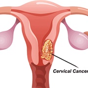 Cervical Cancer