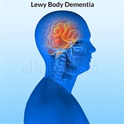 Lewy Body Dementia