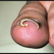 Had an Ingrown Toenail
