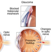 Glaucoma