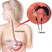 Oesophageal Cancer