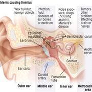 Tinnitus