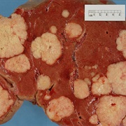 Liver Tumor