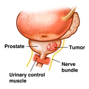 Prostate Tumor