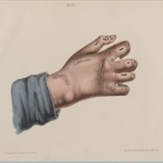 Leprosy Prevention Day (January Sunday)