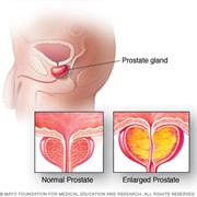 Benign Prostate Enlargement