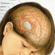 Developmental Disability