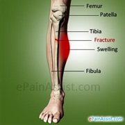 Treat a Leg Fracture