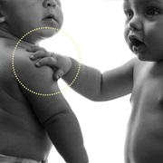 Loss of Sense of Touch