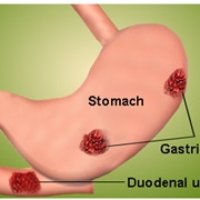 Digestive Ulcers