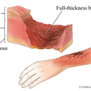 Burn Awareness Week (February)