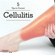 Cellulitis