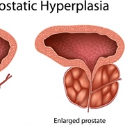 Enlarged Prostate