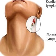 Non-Hodgkin's Lymphoma