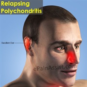 Relapsing Polychondritis