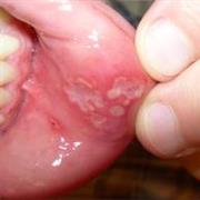 Mouth Ulcer