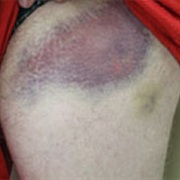 Contusion