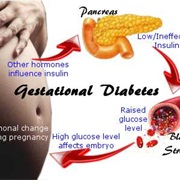 Gestational Diabetes