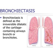 Bronchiectasis