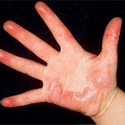 Burn/Scalding