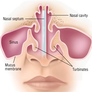 Deviated Septum
