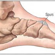 Bone Spur