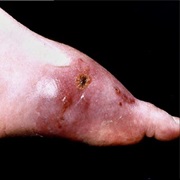 Aspergillosis Day (February 1)