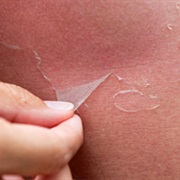 Picking at Peeling Sunburnt Skin