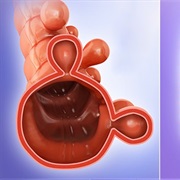 Eating Nuts, Popcorn or Seed Increases Risk of Diverticulitis