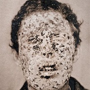 Great Smallpox Epidemic, North America - 1775-1782