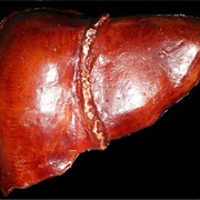 Liver Faiure