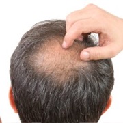 Hair Loss Awareness Month (August)