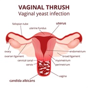 Vaginal Thrush