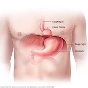 Hiatus Hernia