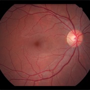 Retinal Detachment
